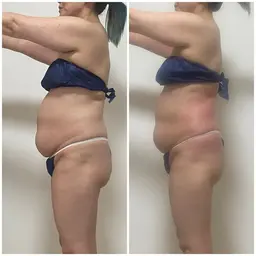 激痩身!!当店NoIスライドカッピング全身40分+骨盤矯正25分+腸もみ25分+ヒートマット付き