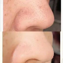 乳酸ピーリング＆毛穴洗浄全顔