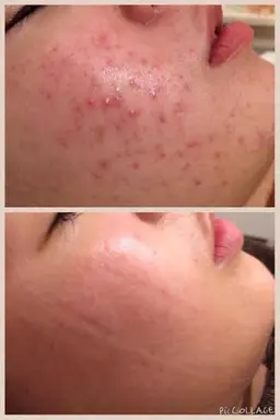 限定🌟【剥離なしピーリング＆鎮静・毛穴収縮Wパックコース】ニキビ/アトピー/毛穴レス/水光肌/ノーファンデ