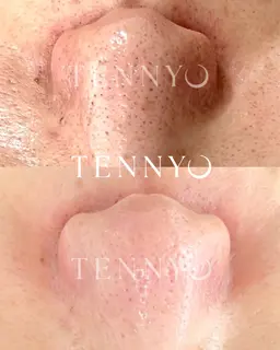 【TENNYO毛穴洗浄】通常¥7700→