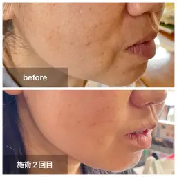 【デコルテ+フェイスケア】ほうれい線、しわ、たるみ、肝斑、くすみ、乾燥等…すっきり小顔&ふっくらバストに♪