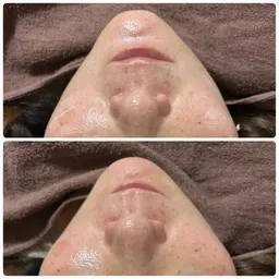 艶肌メニュー🤎【白玉wax脱毛✖️小顔エステ】この時期乾燥しがちな肌に❣️