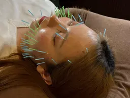 美容鍼初回トライアルコース