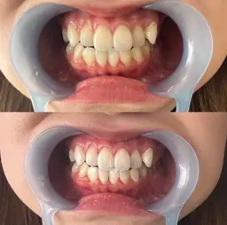 【ミニモ学割U24】学生さん必見★ライトホワイトニング初回★¥1600