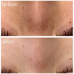 大人気❕ハーブピーリング🌿