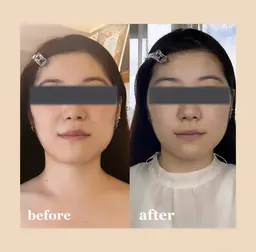 【❄️12月限定❄️】毛穴ケア・リフトアップエステ＊ホームケア1週間分プレゼント🎁