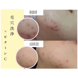 【黒毛穴×ニキビケア】大人気!全顔毛穴洗浄+スーパービタミンC微弱電流導入+ミニモ限定高保湿クリーム¥5500