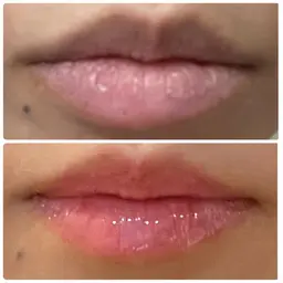 【ローマピンク🩷無料相談30分】バストトップ・唇の黒ずみVIOを赤ちゃんピンクへ