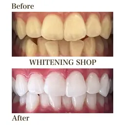 【静岡市在住の方限定】当店初回セルフホワイトニング40分 1000円(口コミ必須)