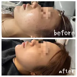 【毛穴/ニキビ/ニキビ跡に💆‍♀️】最新針入りハーブピーリング