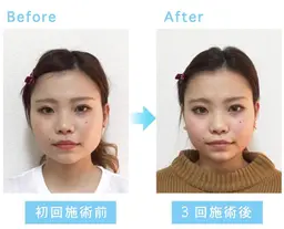 歪み・エラ・むくみ・小顔矯正（整顔）ベーシック 45分