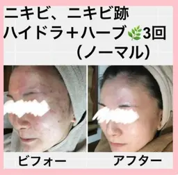 🌿ハーブピーリングソフト&(毛穴洗浄、角質除去、美容保湿)🌿吹き出物、吹き出物跡、毛穴、美白、黒ずみ、赤み等に🩷