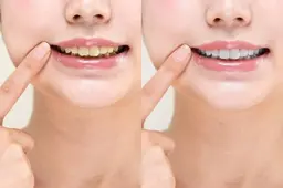 ☆12月限定☆1回で分かるホワイトニングモニター♪2回分💘