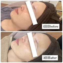 ハーブピーリング【しみ、シワ、たるみ】