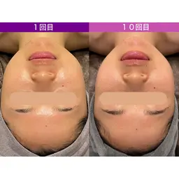 【🇰🇷小顔コルギ】60分×❸回チケット🌟1月限定🌟㊙️クーポンです🙊9000円/1回🙊