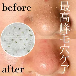 【脱！いちご鼻】毛穴エクストラクション(角栓除去)クチコミご協力でマーメイドセルトリートメントサービス！