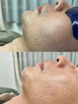 初回限定 #メンズ顔脱毛（お髭込み）（フェイスパックつき）