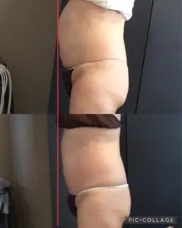 【とにかく痩せたい】ボコボコなセルライトに！メリハリボディを目指してサイズダウン★選べる2ヶ所選択★ハイパーナイフ