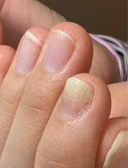 急募☆爪甲剥離症☆自爪育成モデル募集♪初回育成オイル込み価格/２回目以降¥5,660