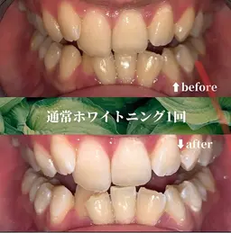 【期間限定】理想の白さへ◎セルフホワイトニング30分照射 初回体験