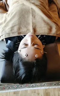 リベルシフォンピーリング＋美容鍼