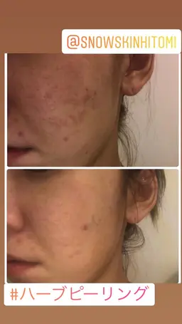 【周年感謝祭★先着10名】肌生成ピーリング★古い角質を除去し、厚くなった角質を薄くし、肌再生を促します♪ 30分　ニキビ