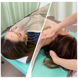 【美容鍼＋小顔矯正✨】人気メニュー🌟迷ったらこちら🙌美容鍼と小顔矯正の相乗効果でさらにスッキリ‼️