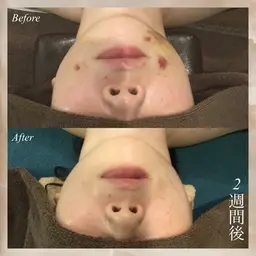 15分顔術後ケア 新規/2200円 再来/2600円【ボディ不可】◆10分延長1200円/15分1700円