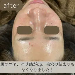 【大分最安値！人気No.1】シミ、シワ、たるみが本気で気になる方へ！効果が分かりやすい、剥離しないピーリング