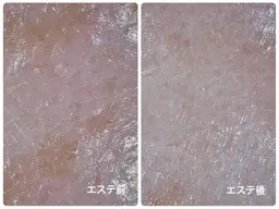 リフトアップ/美白/毛穴引き締め効果あり🫧超音波エステ