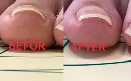 巻き爪ケアコース✳︎韓国初開発の特殊ジェルを使用して巻き爪ケアさせて頂きます✳︎2母趾¥6.600-角質ケア込み✳︎