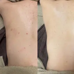 背中ニキビケア！夏までに背中美人☀️背中ハーブピーリング