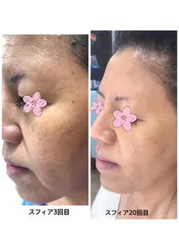 3Dスフィア　ヒアルロン酸エステ