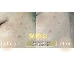 【小顔シミケア×水光肌】光フォト＋ツヤ肌ララピール