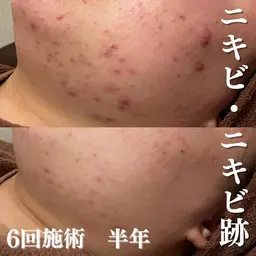 《ニキビ跡が気になる方》肌トーンアップピーリング&パック🌼フットマッサージ付き