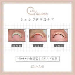 巻き爪ケア1本【Hey Switch】