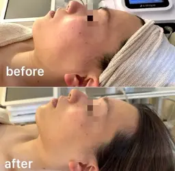 【最強小顔】贅沢3種マシン🌈小顔あごたるみ❤️‍🔥アタックマシン2種✨＋選べる毛穴洗浄or美容液ポレーション導入♡