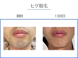 メンズ髭脱毛【あご/あご下/ほほ/鼻下/もみあげ/首】まるっと全パーツ❣️¥5,500→¥3,300最新脱毛器使用✨️