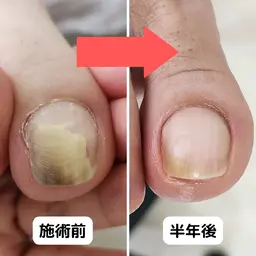 変色・変形・肥厚爪のケア