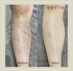 【リニューアルオープン価格】　🗣️通常価格25,500円　⭐️男性　セミ全身脱毛（お顔・VIO無し）