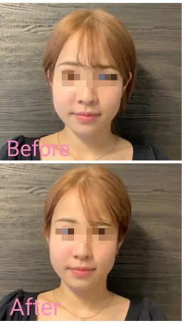 美容鍼トライアル