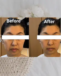 即美顔エステ（顔のむくみ・たるみケア）