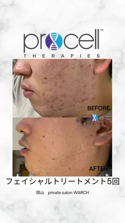 【本気の肌質改善】プロセルフェイシャル（ニキビケア）￥50,000→￥40,000
