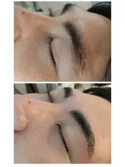 HBL(ハリウッドブロウリフト)