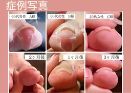 ヘイスイッチ【巻き爪ケア】