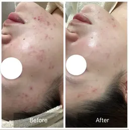 【毛穴/肌荒れ/ニキビケア】クリスティーナ🌿ビオフィート剥離なしハーブピーリング 60分 ¥12500→¥9800