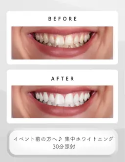 イベント前に集中ホワイトニング！30分照射¥5,980