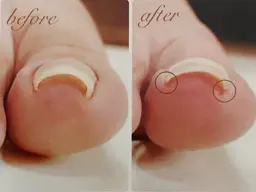 💎巻き爪矯正💎両足 4月～新メニュー✨️