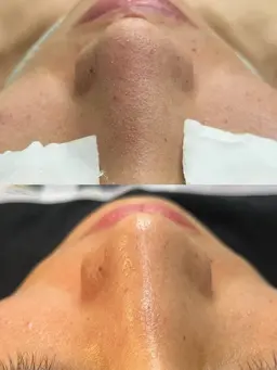 ハイドロスプラッシュ毛穴洗浄✨