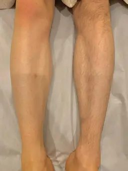 今日からツルツル🌝【メンズワックス脱毛】VIO¥13,200→¥6,600